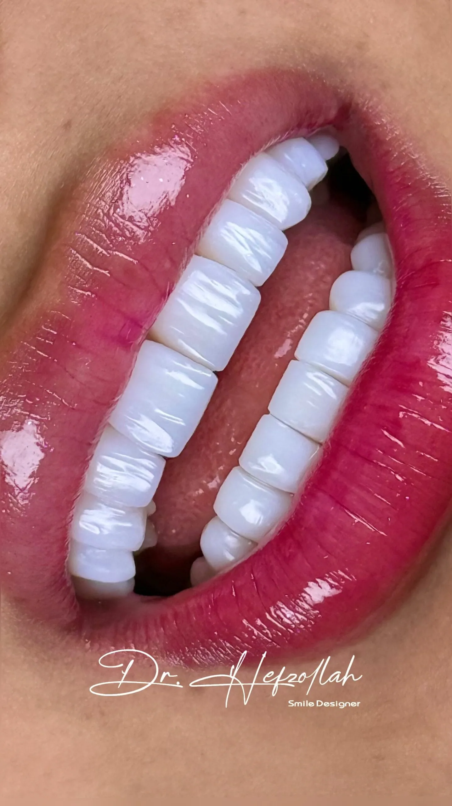 کامپوزیت ونیر — نمونه‌کار واقعی