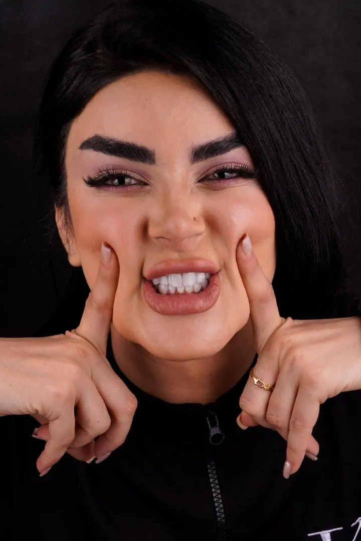 لمینت سرامیکی — نمونه‌کار واقعی دکتر پوریا حفظ‌اله