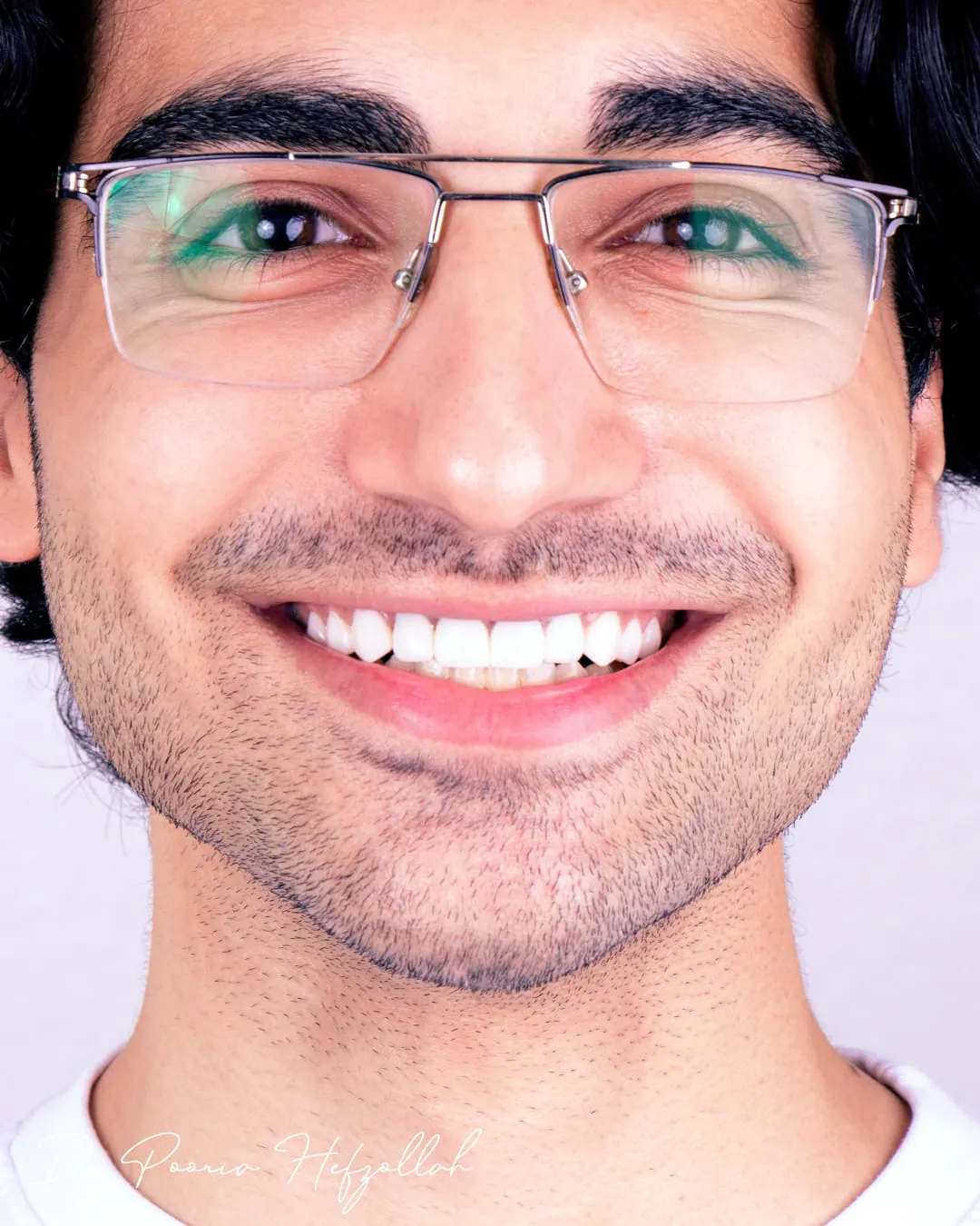 لمینت سرامیکی — نمونه‌کار واقعی